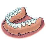 仮歯を使用する例