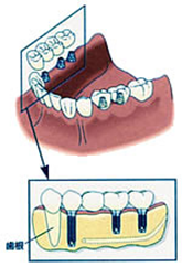 仮歯を使用する例