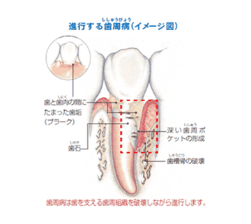 歯周病が進行すると・・・？